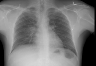 Chest X-rays not needed to screen for lung infection in most